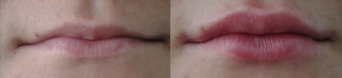 Увеличение губ гиалуроновой кислотой фото до и после (врач Ратникова С.В.)