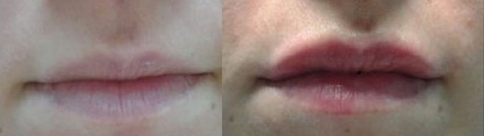 Увеличение губ гиалуроновой кислотой фото до и после (врач Ратникова С.В.)