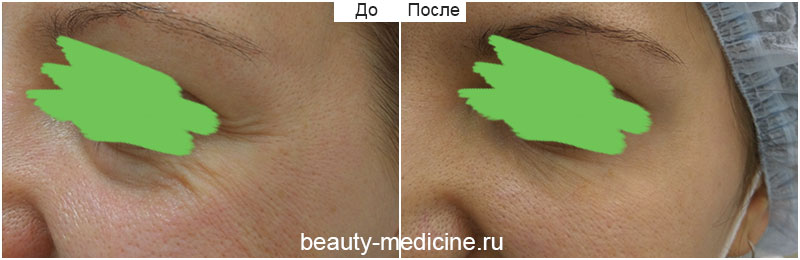 Морщинки вокруг глаз — коррекция ботоксом (врач Ратникова С.В.)