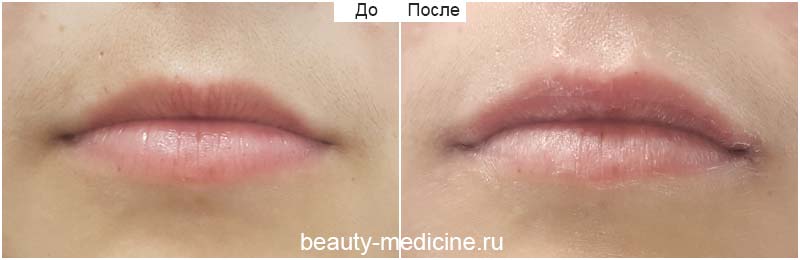 Контурная пластика губ гиалуроновой кислотой (врач Соловых Н.А.)