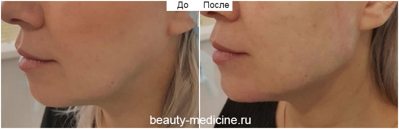 Коррекция овала лица Радиесс, фото до и после, врач Соловых Н.А.