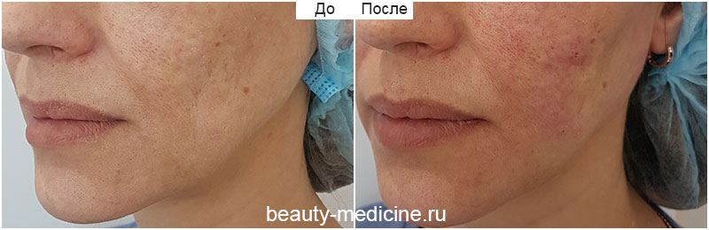 Коррекция овала лица Радиесс, фото до и после, врач Соловых Н.А.