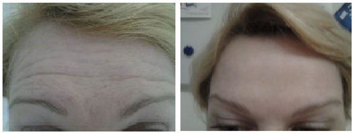 Инъекции ботокс для лица фото до и после