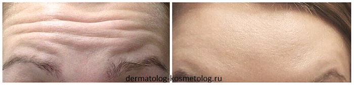 Инъекции ботокс для лица фото до и после (врач Щербакова В.В.)