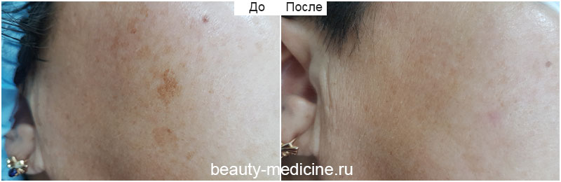 Фотоомоложение пигментации лица (врач Соловых Н.А.)