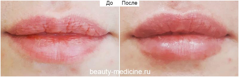Увеличение губ гиалуроновой кислотой (врач Ратникова С.В.)