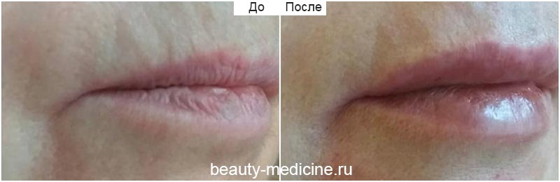 Увеличение губ гиалуроновой кислотой (врач Ратникова С.В.)