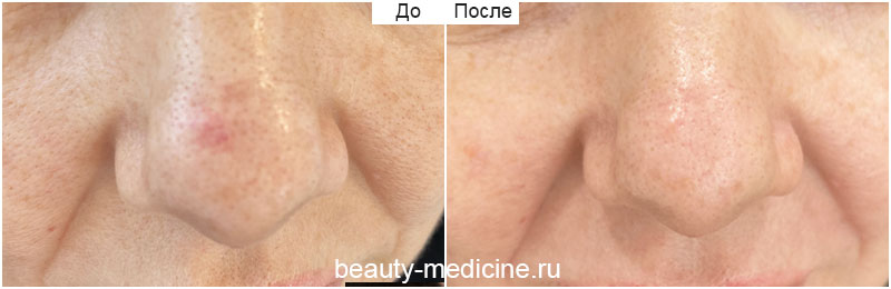 Удаление гемангиомы на носу (Врач Алмазова А.А.)