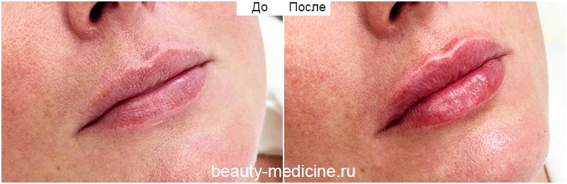 Увеличение губ гиалуроновой кислотой (врач Гусейнаджиева М.З.)