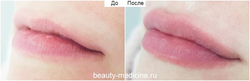 Увеличение губ гиалуроновой кислотой (врач Рябушева А.В.)