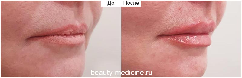 Контурная пластика губ гиалуроновой кислотой (врач Ратникова С.В.)